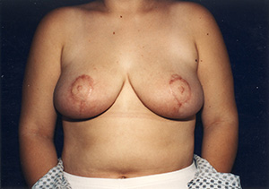 Breast Reduction 4b